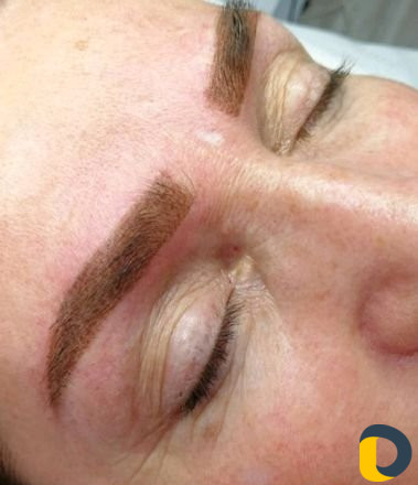 Микроблейдинг