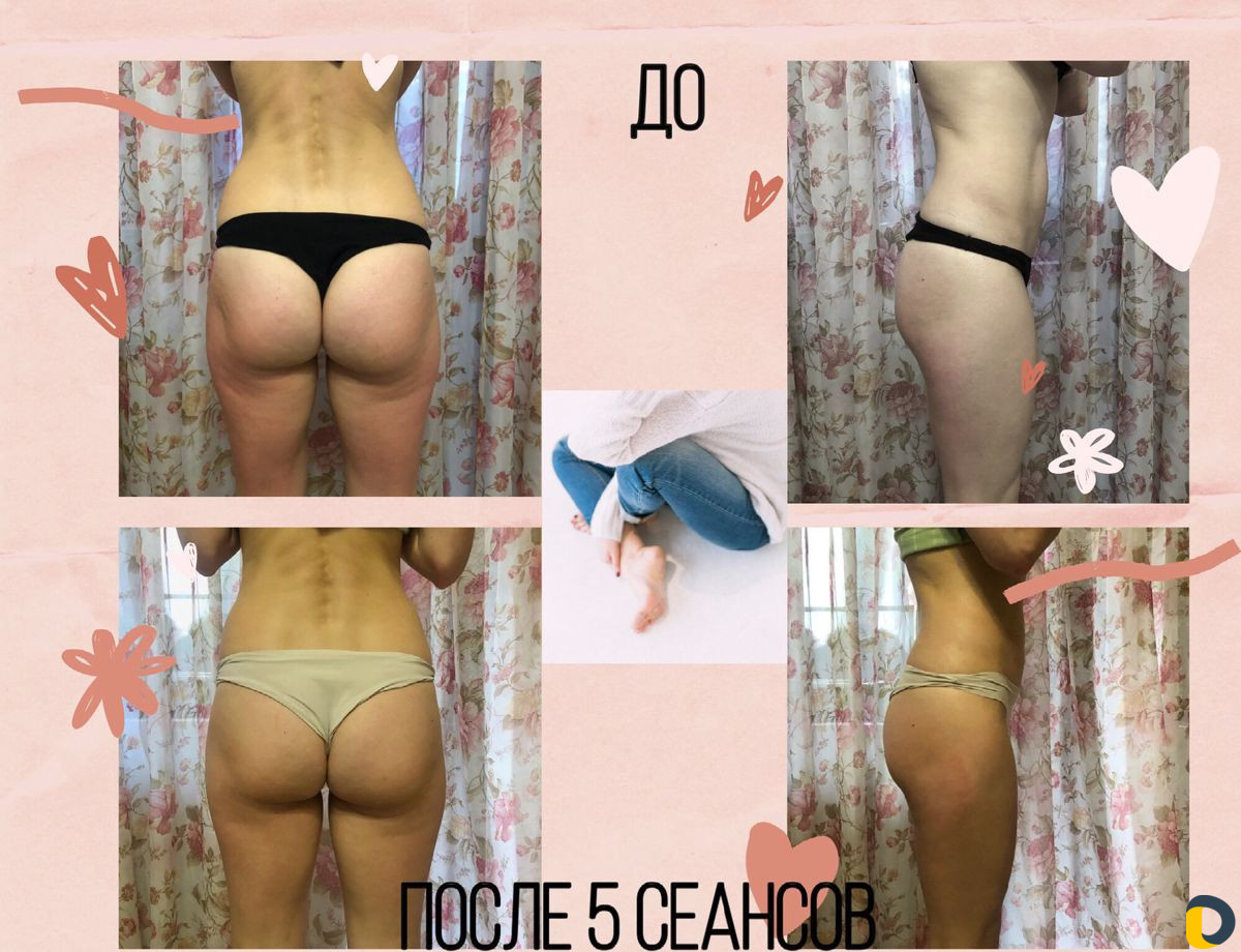 Модели Антицеллюлитный массаж