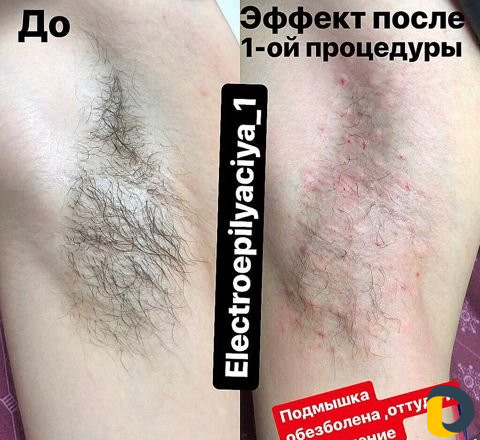 Обучение электроэпиляции с выдачей сертификата