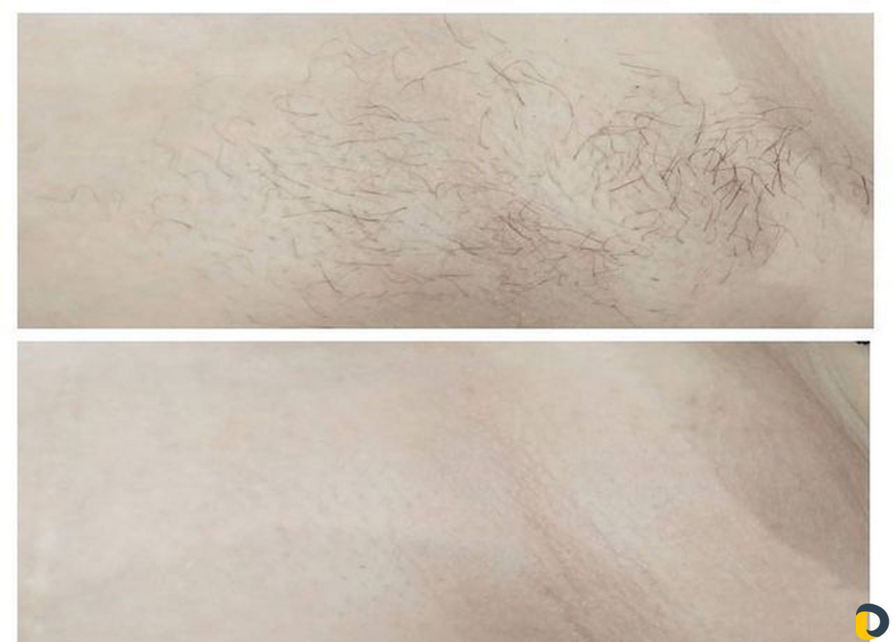Обучение инновационной эпиляции Skin’s