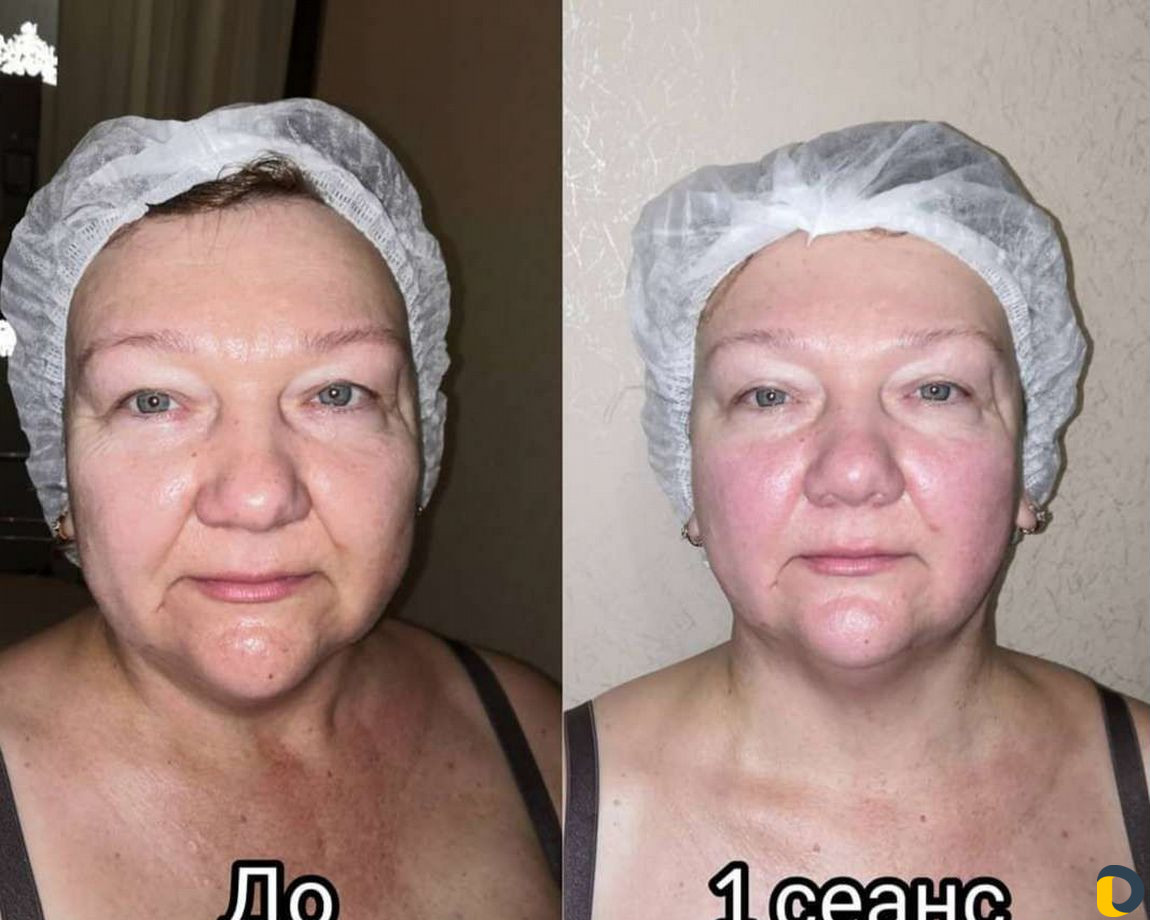 Омолаживающий массаж лица
