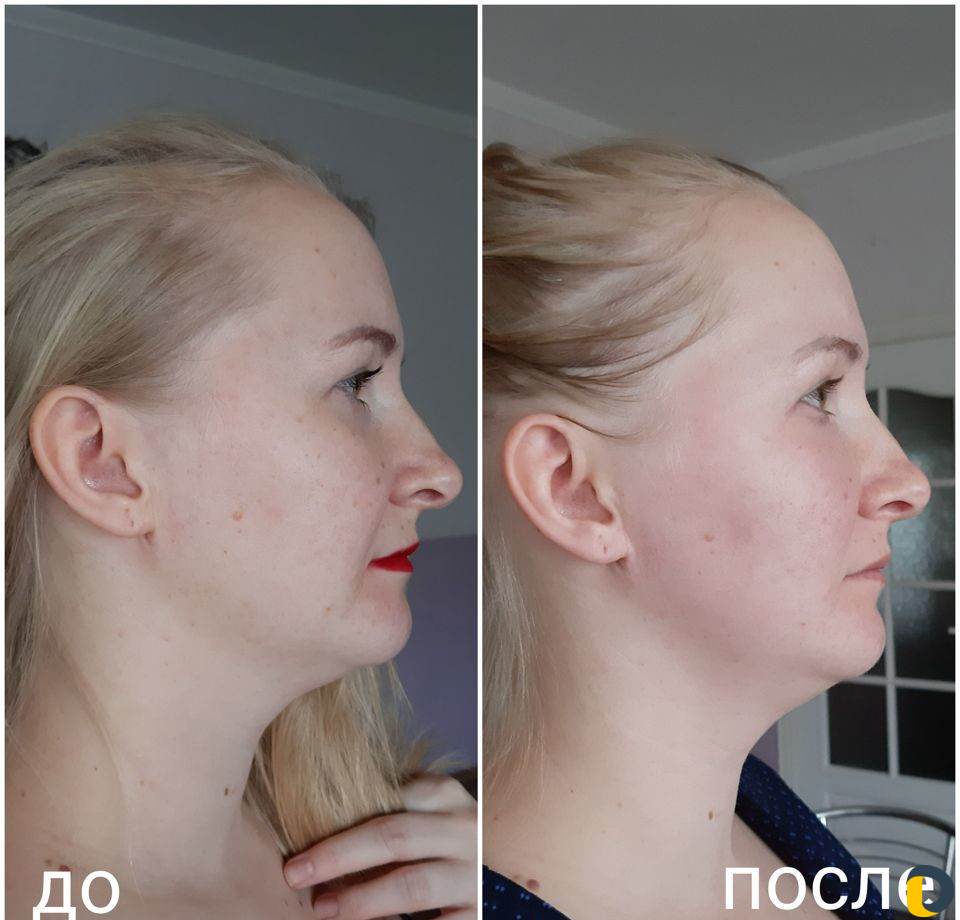 Омолаживающий массаж лица
