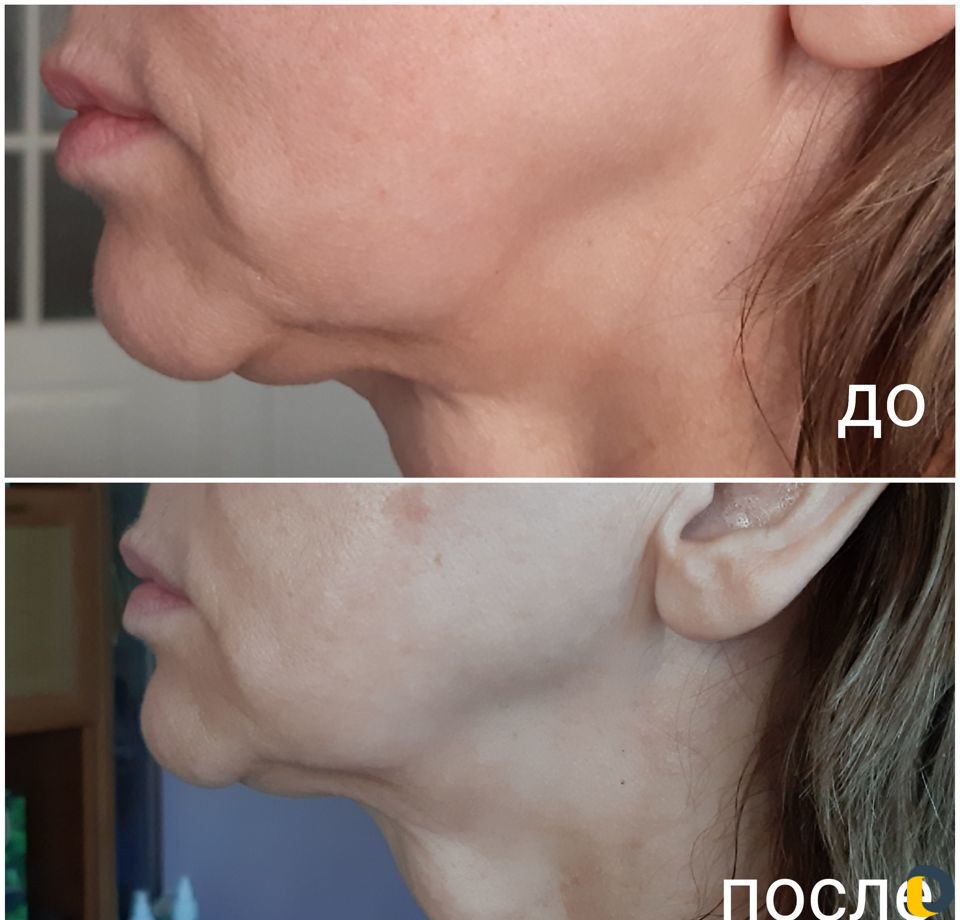 Омолаживающий массаж лица
