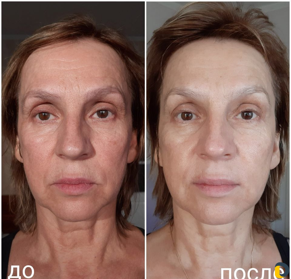 Омолаживающий массаж лица