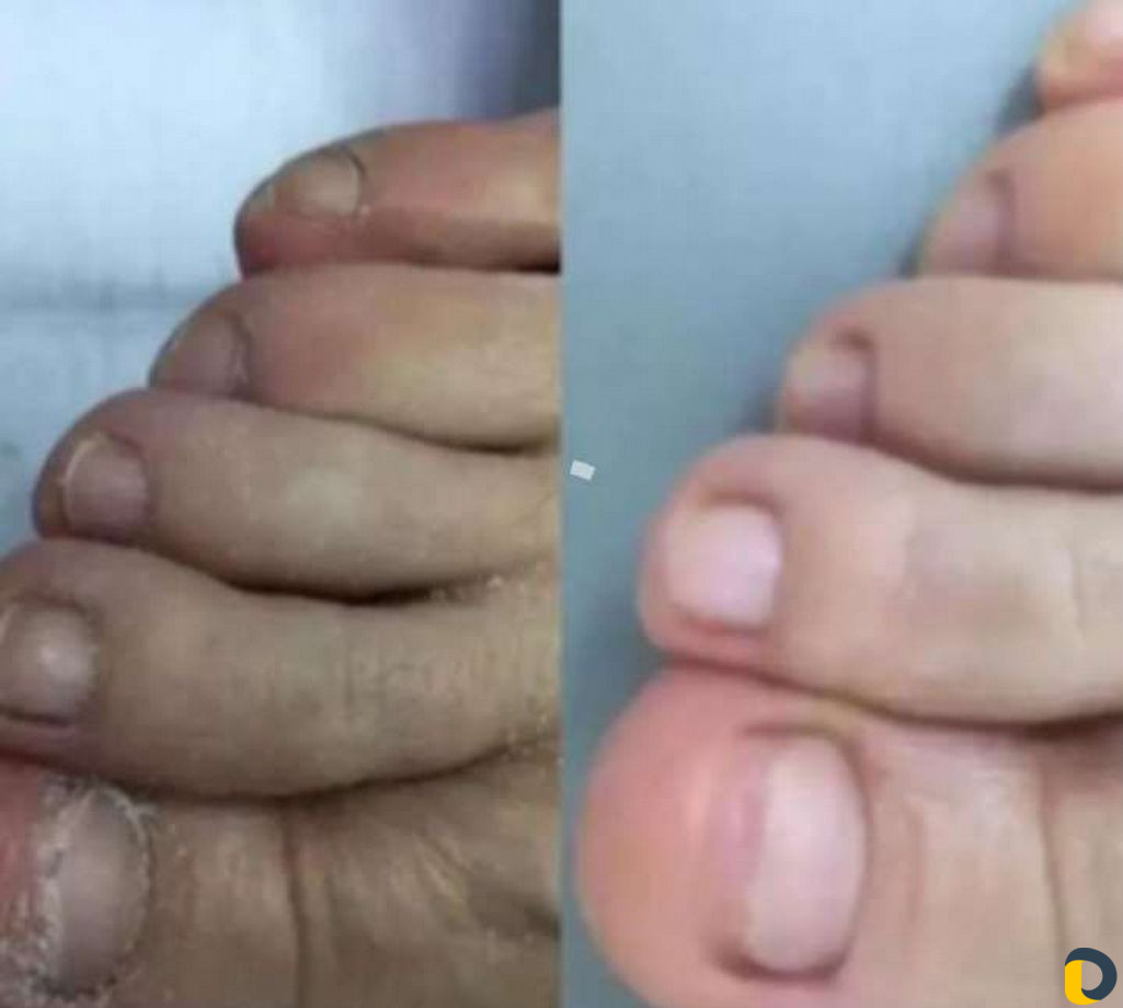 Педикюр медицинский