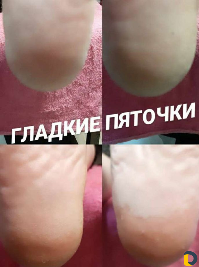 Педикюр
