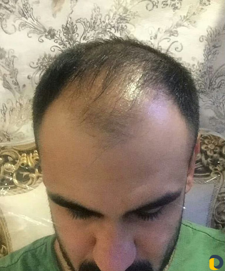 Пересадка волос в Иране