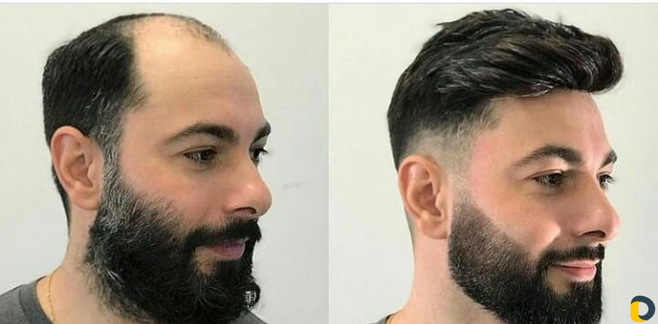 Пересадка волос в Иране