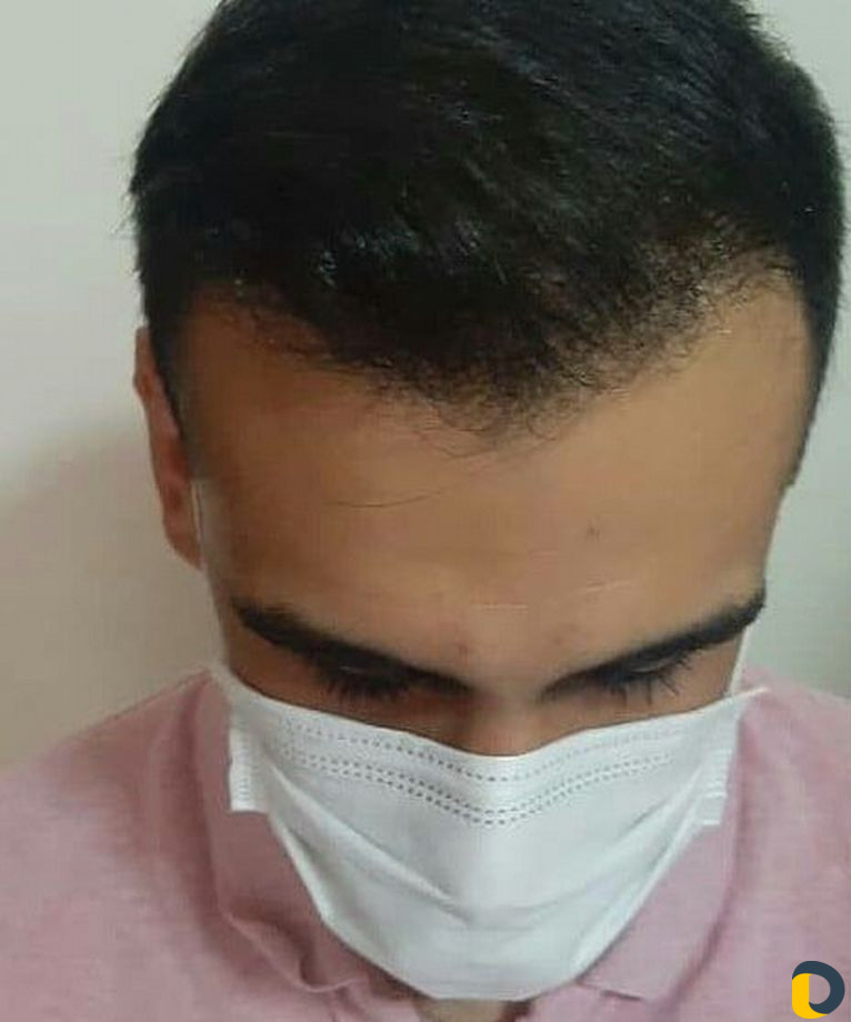 Пересадка волос в Иране