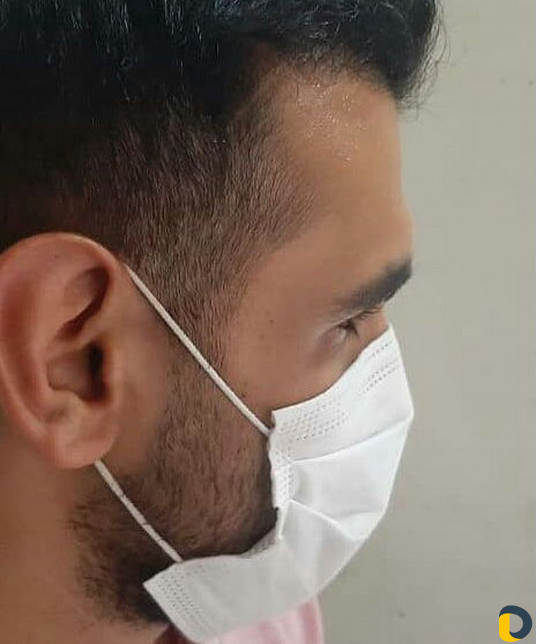 Пересадка волос в Иране