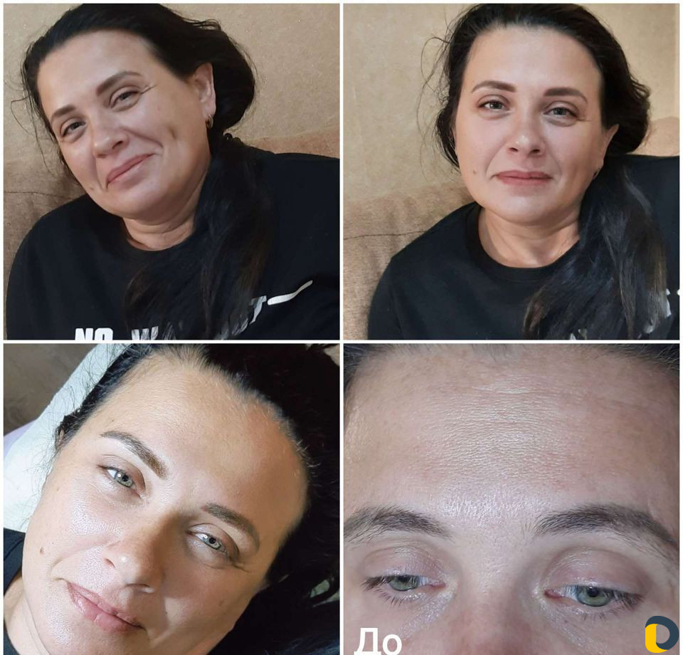 Перманентный макияж, удаление