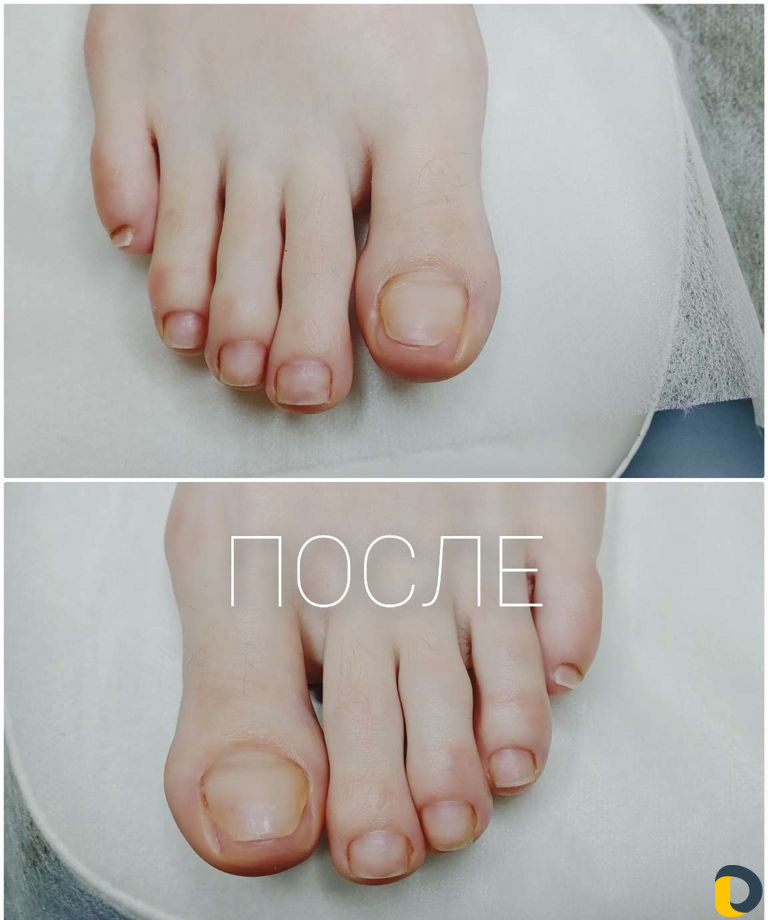 Подолог, аппаратный медицинский педикюр