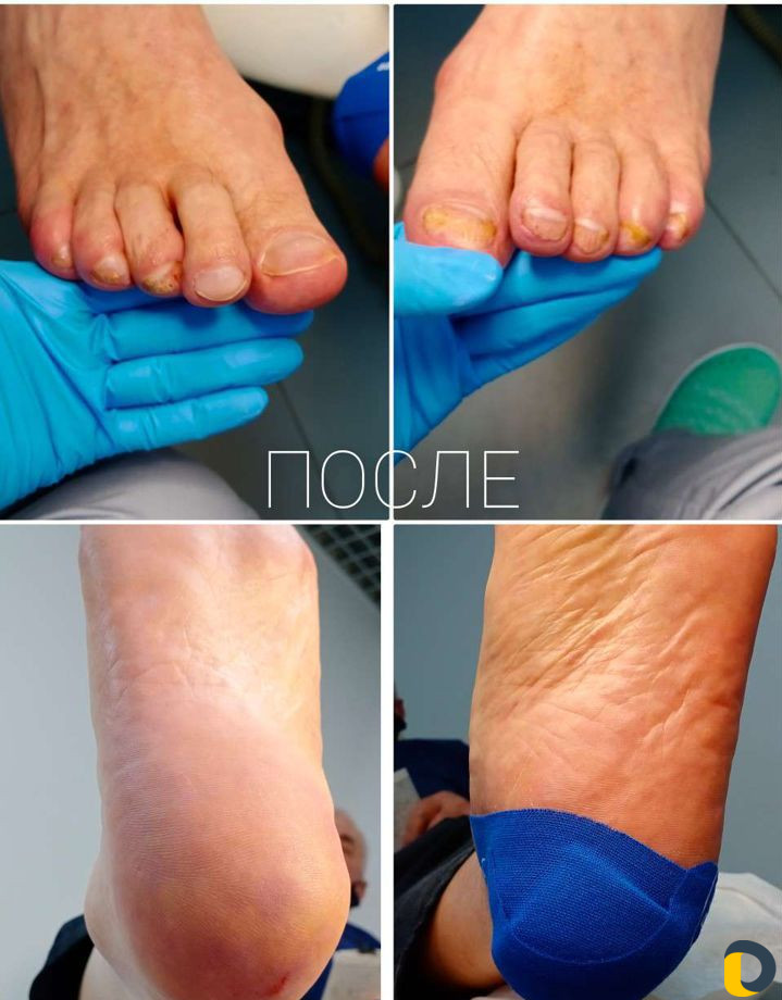 Подолог, аппаратный медицинский педикюр