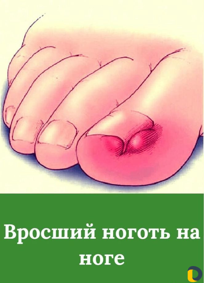 Помощь при вросшем ногте.Педикюр любой сложности