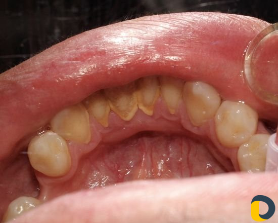 Проф. гигиена полости рта (чистка зубов)