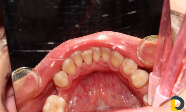 Проф. гигиена полости рта (чистка зубов)