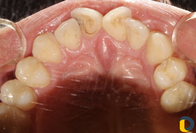 Проф. гигиена полости рта (чистка зубов)