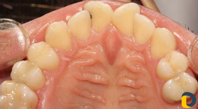 Проф. гигиена полости рта (чистка зубов)