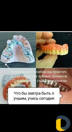 Протезирование