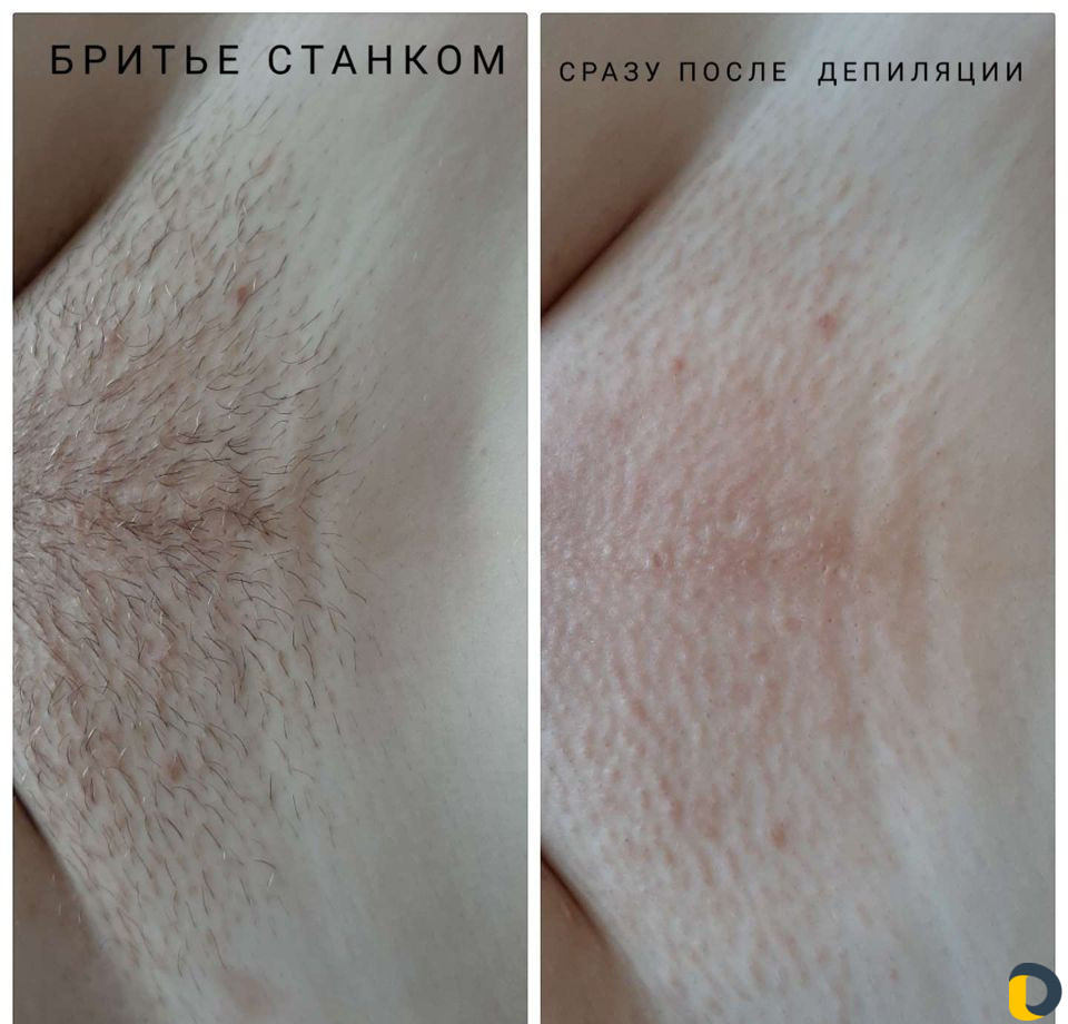 Шугаринг депиляция