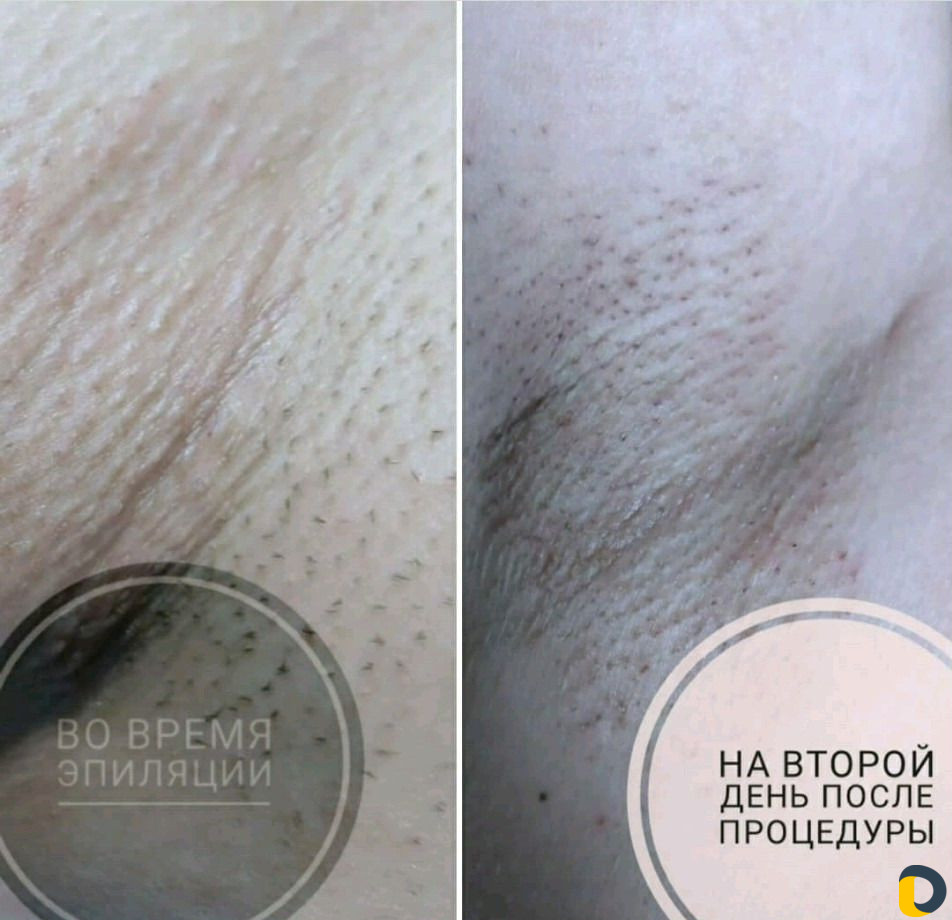 Шугаринг. Электроэпиляция. Эпиляция. Депиляция