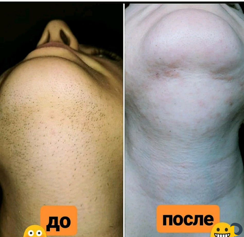 Шугаринг. Электроэпиляция. Эпиляция. Депиляция