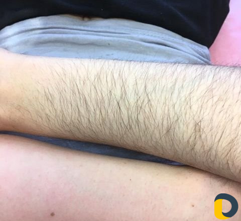 Шугаринг эпиляция тела