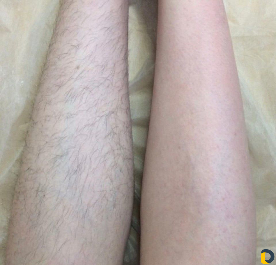 Шугаринг эпиляция