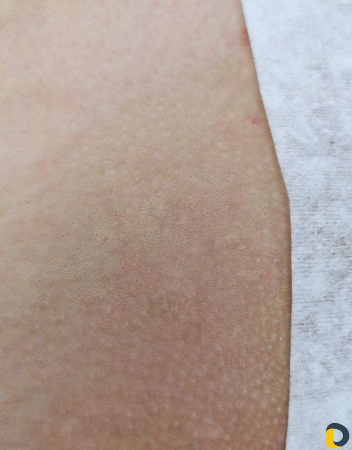 Шугаринг. Обучение. Эпиляция