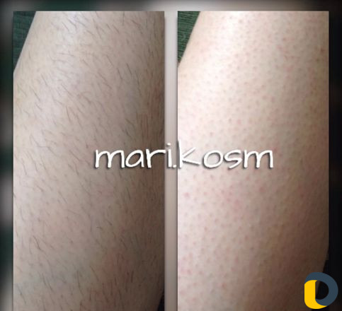 Шугаринг сахарная эпиляция