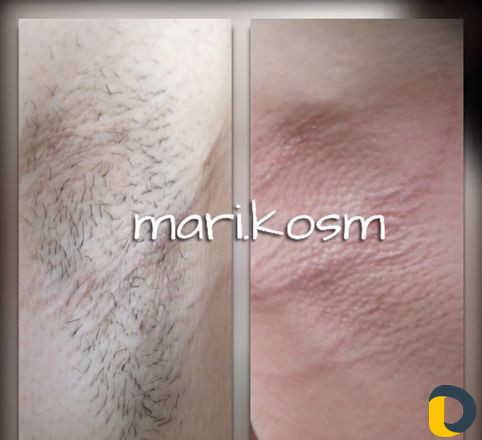 Шугаринг сахарная эпиляция