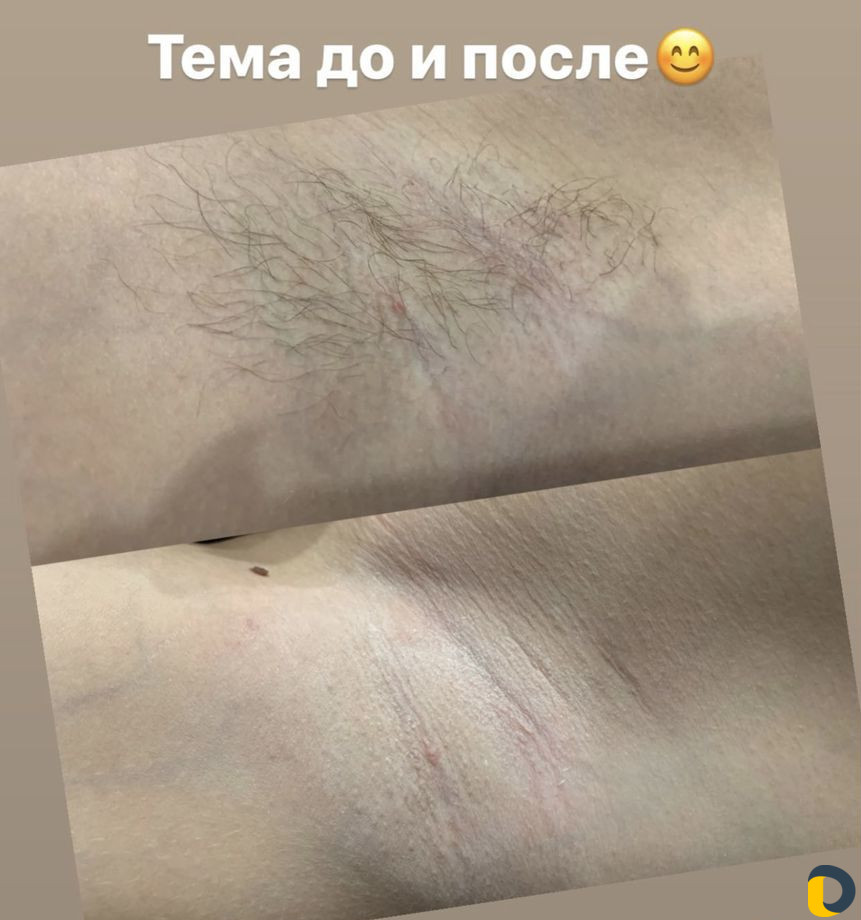 Шугаринг