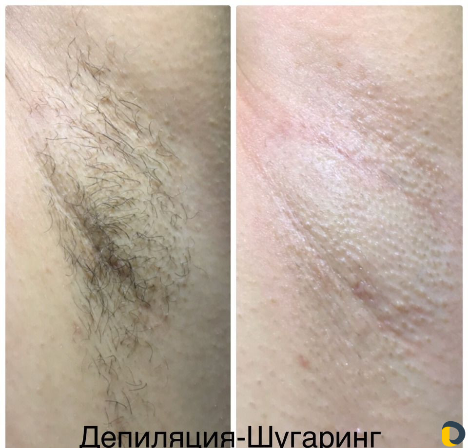 Шугаринг