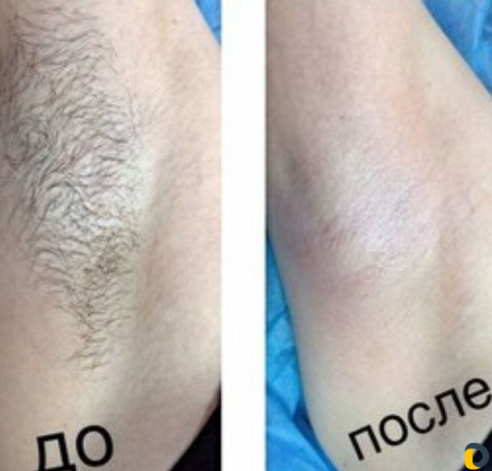 Шугаринг