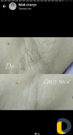 Шугаринг