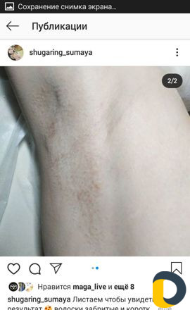 Шугаринг