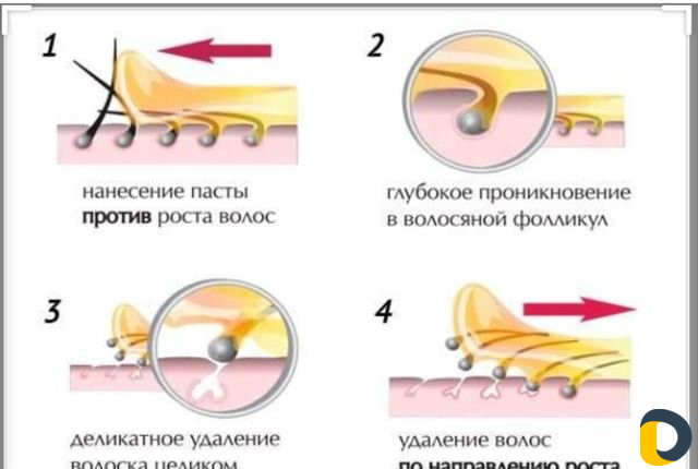 Шугаринг