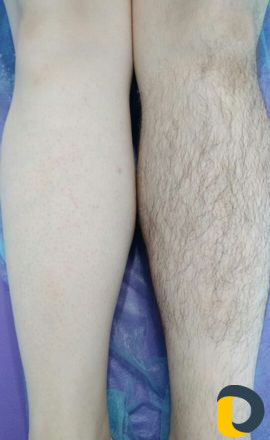 Шугаринг