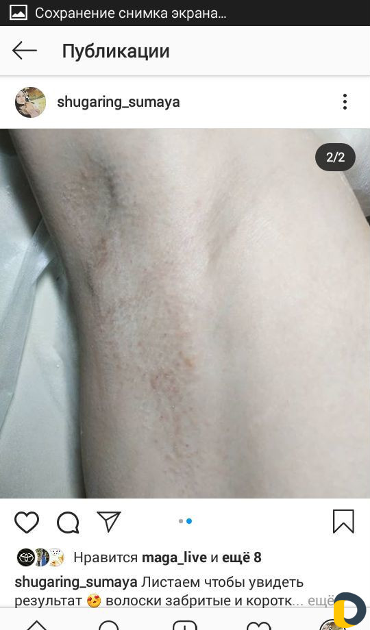 Шугаринг
