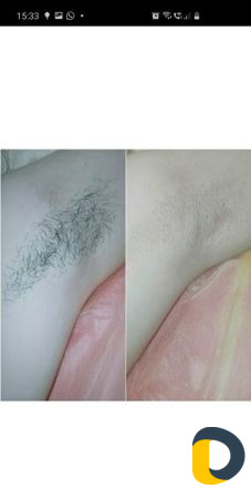 Шугаринг воосковая эпиляция плёночный воск