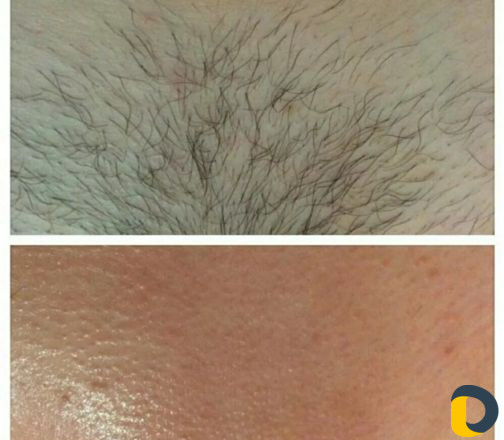 Шугаринг воосковая эпиляция плёночный воск