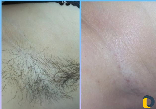 Шугаринг воосковая эпиляция плёночный воск