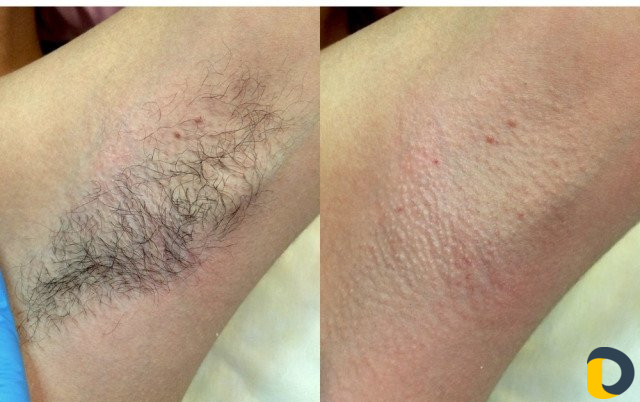 Шугаринг воск ламинирование