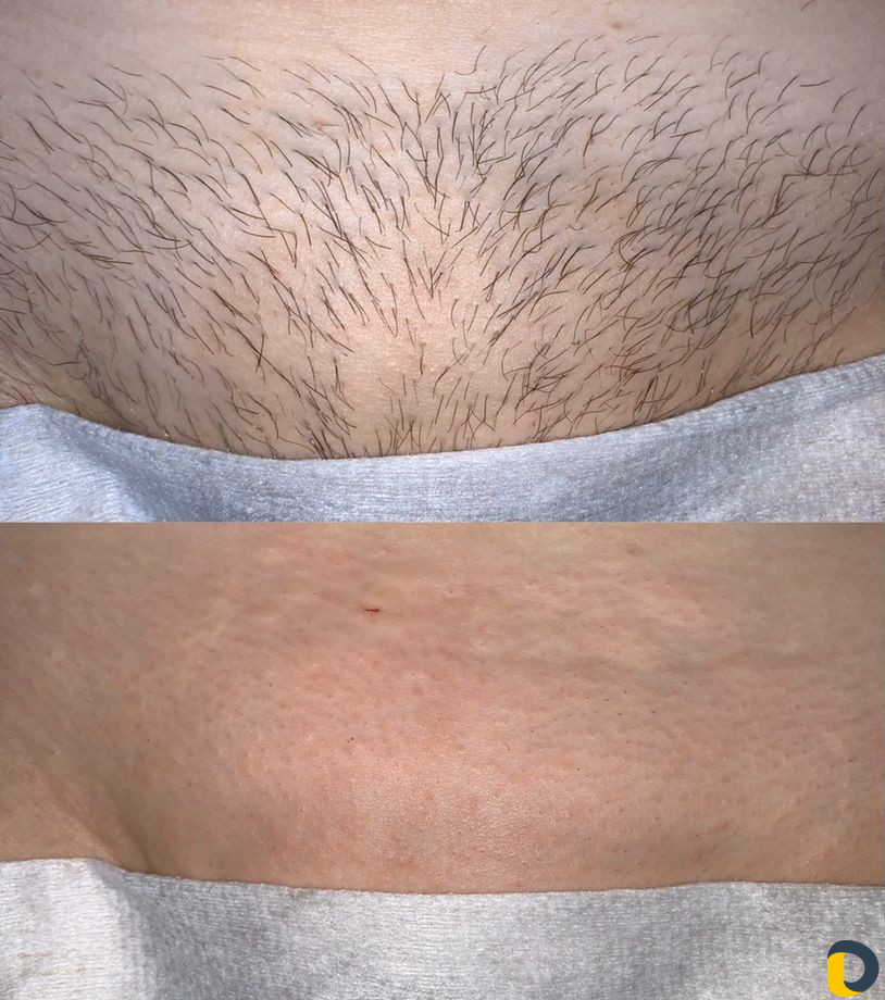 Шугаринг / восковая депиляция / воск