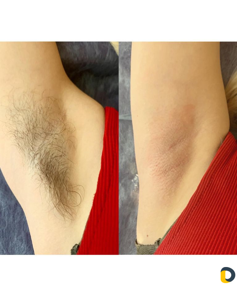 Шугаринг / восковая депиляция / воск