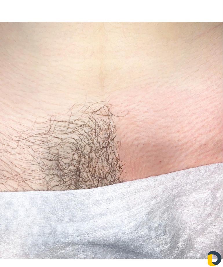 Шугаринг / восковая депиляция / воск