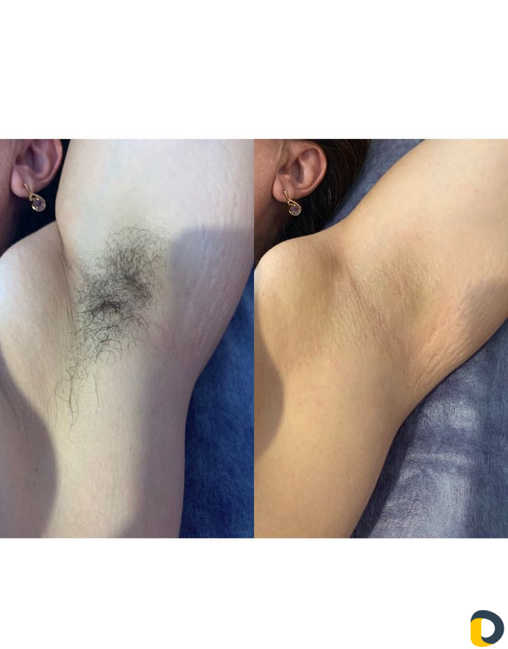 Шугаринг / восковая депиляция / воск