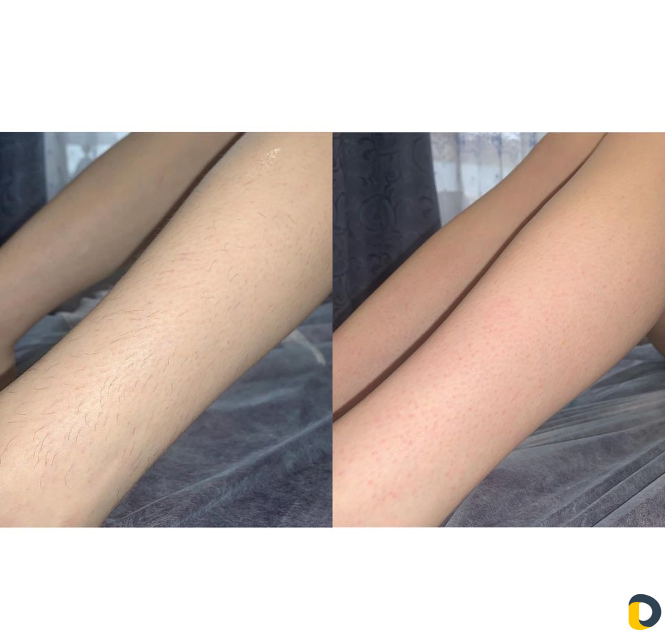 Шугаринг / восковая депиляция / воск