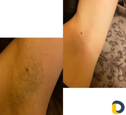 Шугаринг, восковая эпиляция, пленочный воск