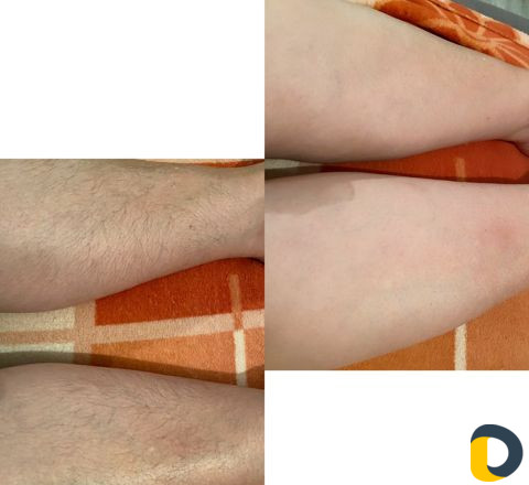 Шугаринг, восковая эпиляция, пленочный воск